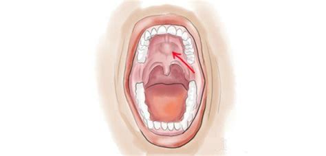 Possible Causes for Bumps on the Roof of Your Mouth - YouMeMindBody