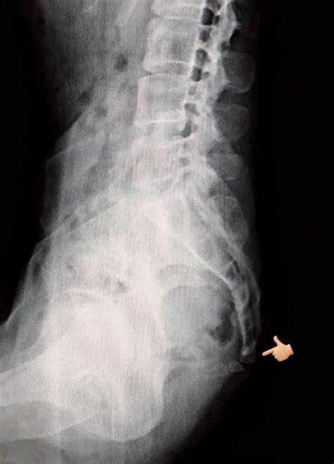 Hassan X-Ray - X-Ray of Coccyx Lateral view The sacrum and...