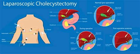 What Is A Cholecystectomy And The Benefits Of The Surgery, 44% OFF