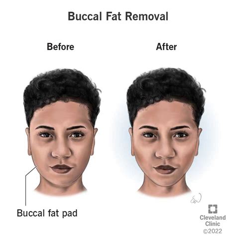 Buccal Fat Removal: What It Is, Recovery & Before & After