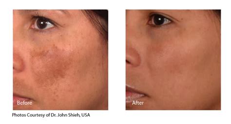 Melasma Treatment - Inkfree, MD Laser Clinic in Houston, TX