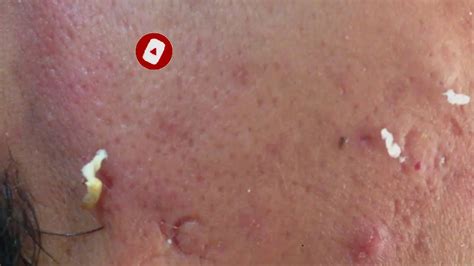 |Blackheads Extraction| |Blackheads Removal| |dr pimple popper office| - YouTube