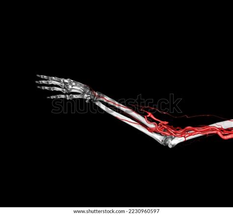 Brachial Arteries Arm Upper Extremity Bone Stock Illustration ...