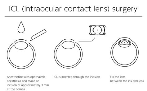 Premium Vector | ICL Intraocular Contact Lens Surgery illustrated