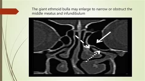 Surgical anatomy of osteomeatal complex