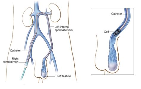 Varicocele | Varicose veins | Vascular surgeon | Stroke | DVT | Leg gangrene | Cancer