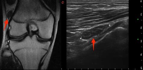 plantaris tendon | coachingultrasound