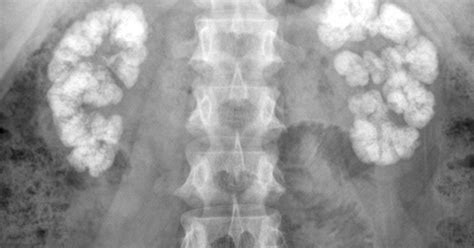 Medullary Nephrocalcinosis-Plain Film - Sumer's Radiology Blog