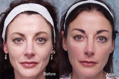 Midface Surgery Case Studies Beverly Hills | Cheek Lift Cases Los Angeles