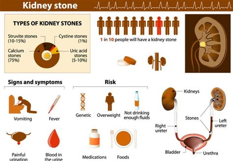 Kidney Stone Size Scale