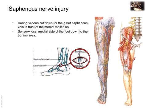 Applied anatomy saphenous nerve injury