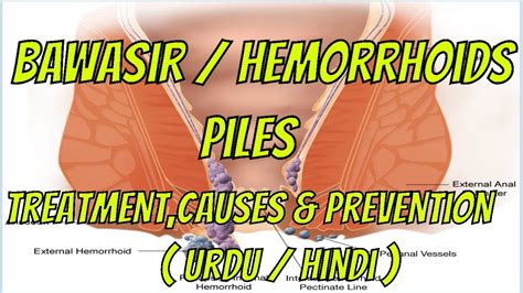 Bawasir/ hemorrhoids/ piles treatment at home, causes & prevention | Unani medicine (urdu/hindi ...