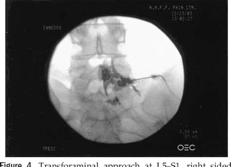 Parasagittal Meningioma | Semantic Scholar