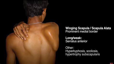 Scapular Alignment | Scapular Dyskinesis Assessment