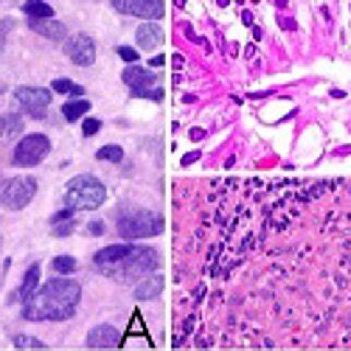 Histology of our anaplastic ependymoma. A Increased mitotic activity... | Download Scientific ...