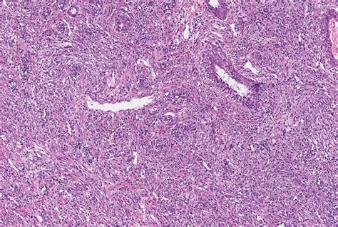 Pathology Outlines - Angiomyolipoma