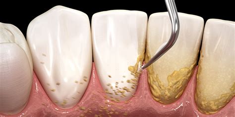 Scaling and Root Planing - Eastern Dental