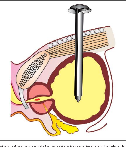 Preventing Inadvertent Placement of Foley Catheter into Prostatic Urethra During Suprapubic ...