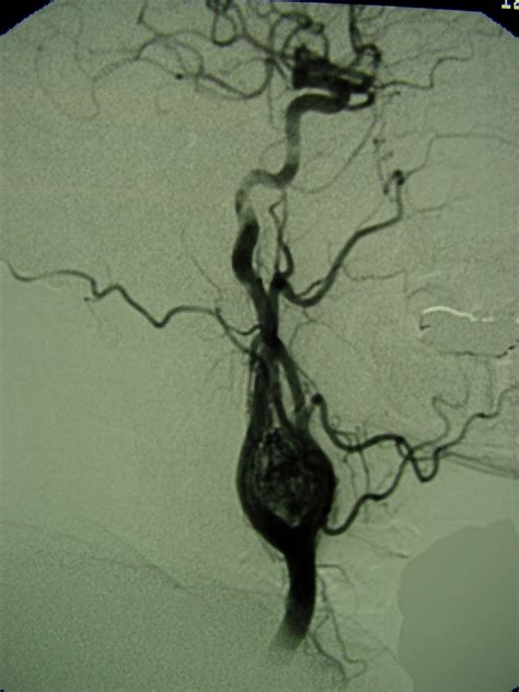 Neural Tumors Paraganglioma 3156 Carotid Body Tumor | Surgery Photos