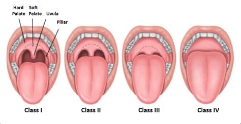 Uvula | News | Dentagama