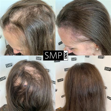 Alopecia Treatment Las Vegas | SMP Ink - Camouflage Hair Loss