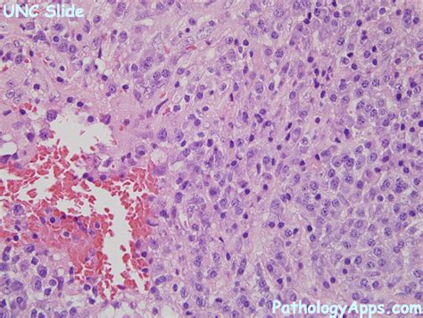 angiomatoid fibrous histiocytoma pathology