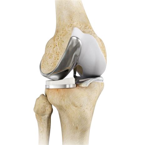 partial knee replacement specialist - Knee & Shoulder Surgeon - Orthopaedic Surgery Specialists ...