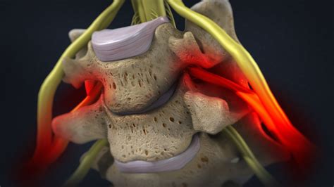 Cervical Disc Arthroplasty (Artificial Disc Replacement) Spine Surgery ...