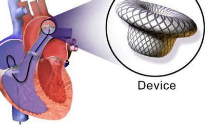 ASD/PDA Device closure - Dr. Hammad's Cardiac Care