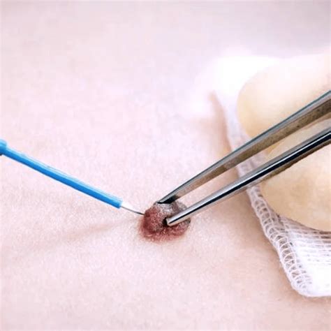 How Cauterization and Electrocautery Works (Skin Tags) – Skintify