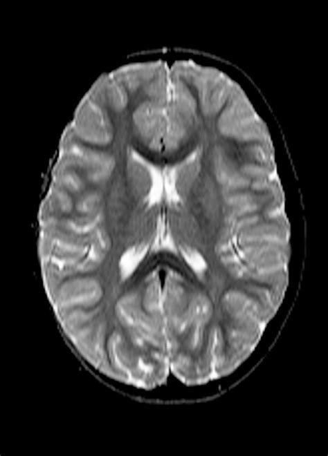 Child's Brain, Mri Scan #4 Photograph by Du Cane Medical Imaging Ltd ...