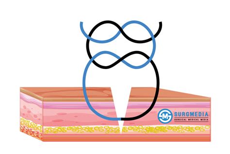 Common Surgical Knot Types | SurgMedia