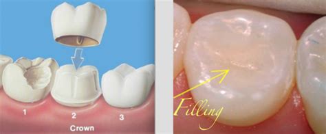 Differences Between Dental Crowns & Fillings - French Dental - Dr.Miski