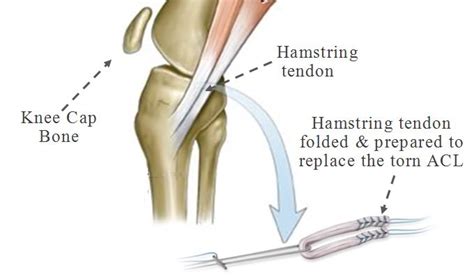 ACL Reconstruction Surgery in Chennai | ACL Reconstruction Surgery Cost ...