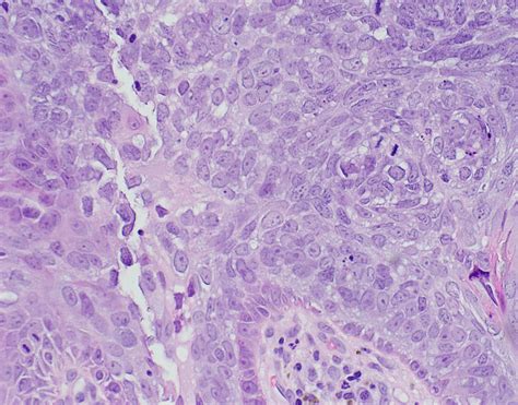 Basal Cell Carcinoma Eyelid Histology