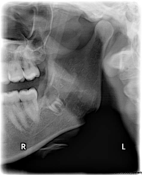 Coronectomy is the Deliberate Removal of the Crown of a Vital Tooth ...