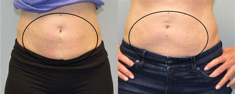 CoolSculpting Before and After Picture of Lower Abdomen - Connecticut ...