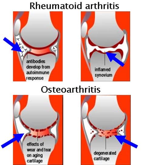 Inflammatory Arthritis of the Hip - Robert Howells