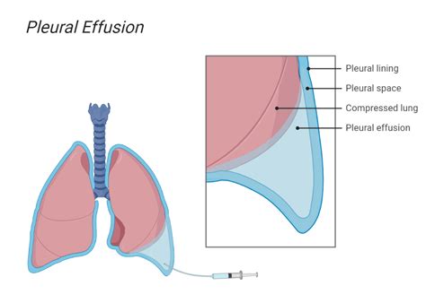 Whispered Pectoriloquy - My Endo Consult