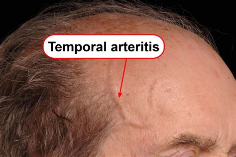 Temporal Arteritis - Giant Cell Arteritis, Takayasu Arteritis