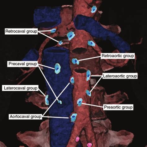 What Is A Paraaortic Lymph Node With Pictures | Images and Photos finder