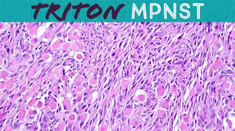 Malignant Triton tumor (MPNST with rhabdomyosarcoma differentiation): Basic soft tissue ...