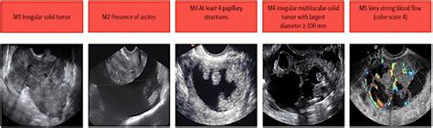 Malignant Ovarian Cyst Ultrasound