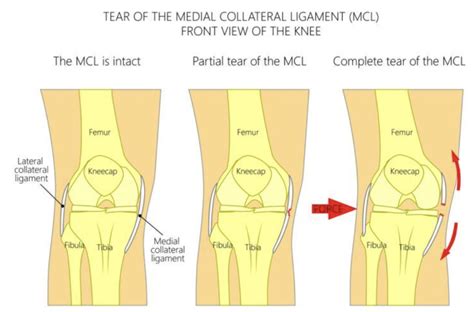 Medial Collateral Ligament (MCL) Injury - Mundaring & Hills