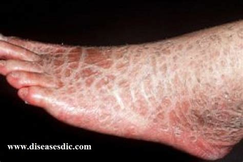 Ichthyosis - Causes, Risk factors, and Treatment.