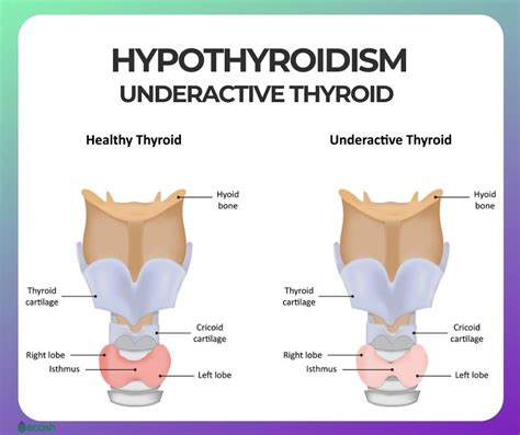 HYPOTHYROIDISM (UNDERACTIVE THYROID) - Symptoms, Causes, Risk Groups ...