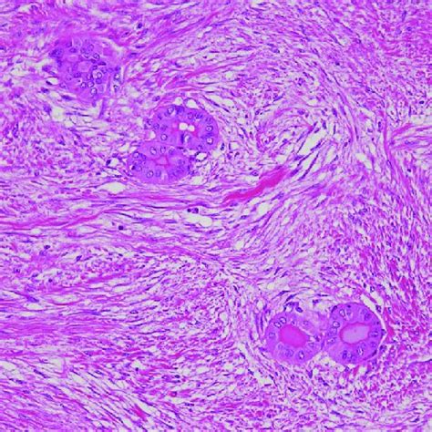 Histology of papillary thyroid carcinoma with desmoidtype fibromatosis ...