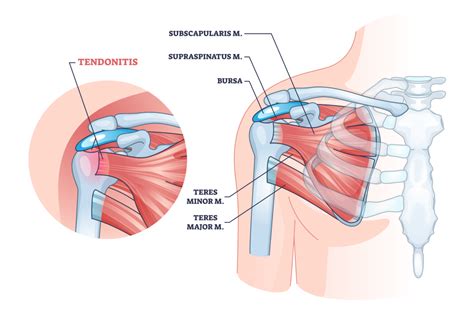 Shoulder Tendonitis: 5 Stretches and 5 Exercises (with Pictures!) - Inspire US