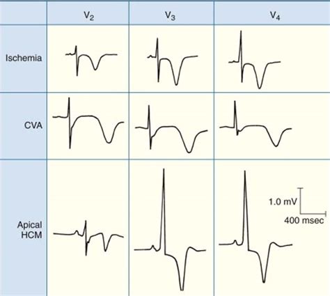 ECG T wave changes and interpretation