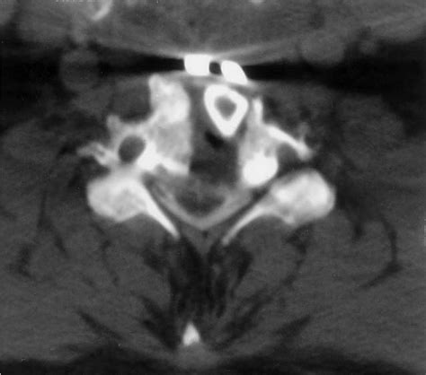 Anterior Cervical Corpectomy | Neupsy Key